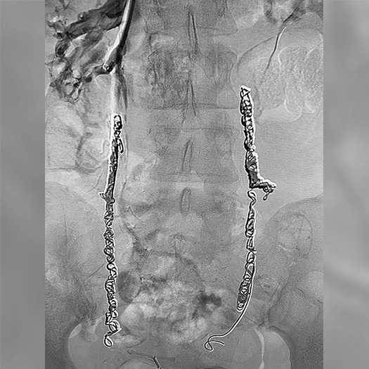 Angiogram of coils deployed in an aneurysm the body