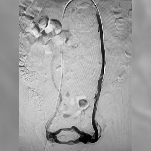 Angiogram of coils deployed in an aneurysm the body