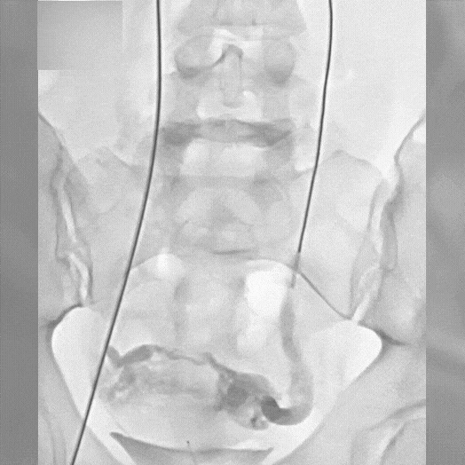 Angiogram of coils deployed in an aneurysm the body