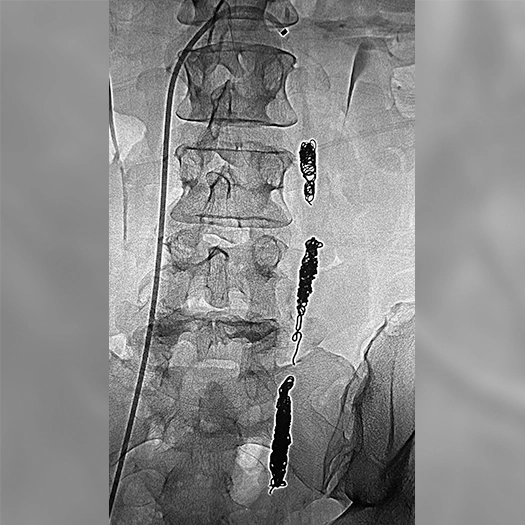 Angiogram of coils deployed in an aneurysm the body