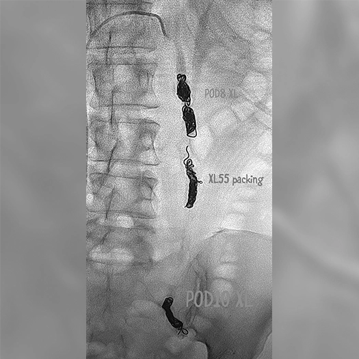 Angiogram of coils deployed in an aneurysm the body