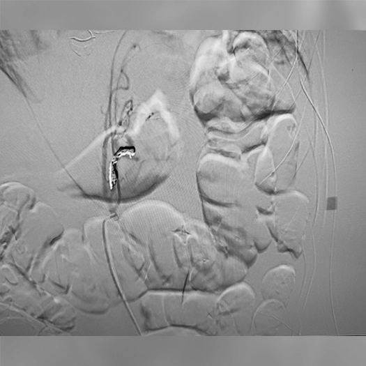 Angiogram of coils deployed in an aneurysm the body