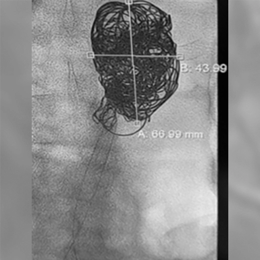 Angiogram of coils deployed in an aneurysm the body