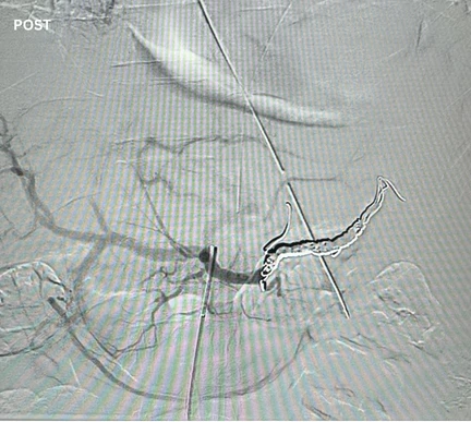 Angiogram of coils deployed in an aneurysm the body
