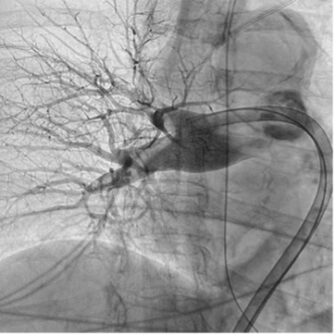Angiogram of pulmonary thrombus