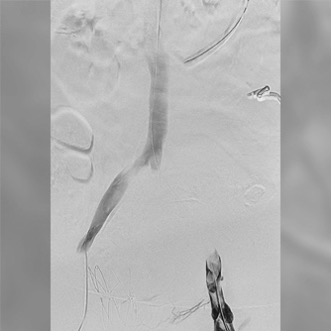 Angiogram of left iliac