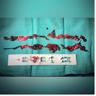 cCot extracted during procedure