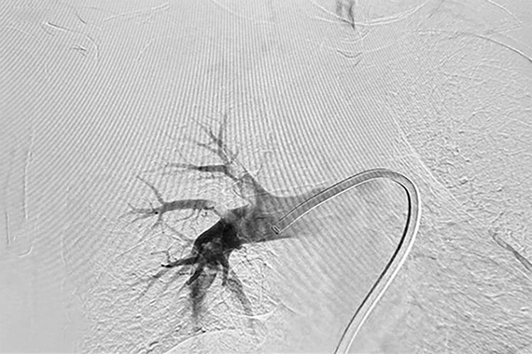 Angiogram of the right pulmonary.