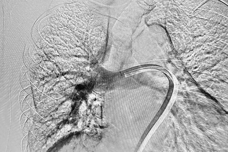 Left pulmonary angiogram