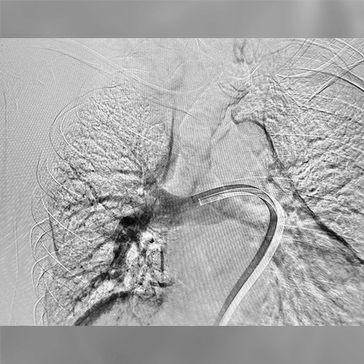 Angiogram of the upper chest showing contrast-filled pulmonary vessels and a curved catheter advancing through a central pulmonary artery