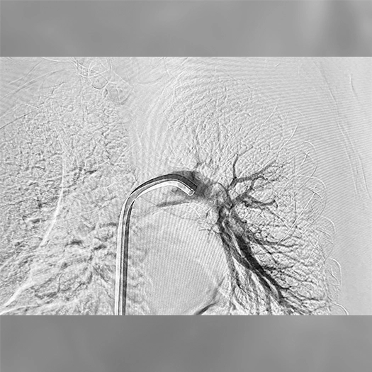 Angiogram showing a catheter tip positioned within a pulmonary artery, with contrast outlining branching vessels in the surrounding lung tissue