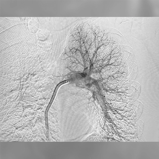 Angiogram showing a branching network of pulmonary blood vessels filled with contrast, with a curved catheter positioned at a central vessel bifurcation