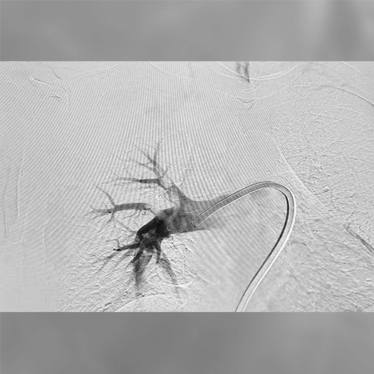 Angiogram of contrast injected through a curved catheter, highlighting a dense cluster of branching pulmonary vessels extending from a central artery