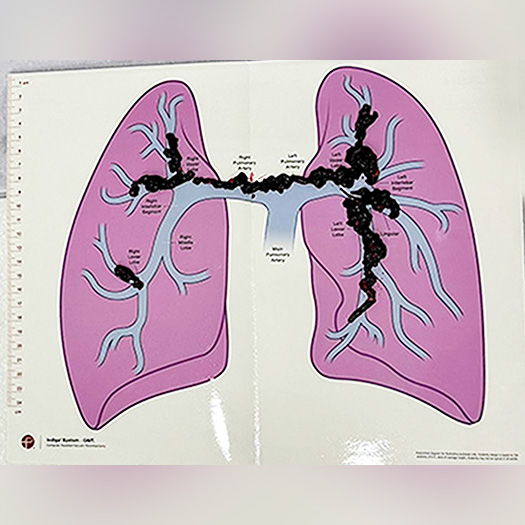 blood clots on lung diagram