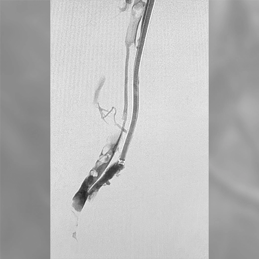 angiogram of a long catheter within a blood vessel, with contrast outlining an elongated intravascular obstruction prior to treatment