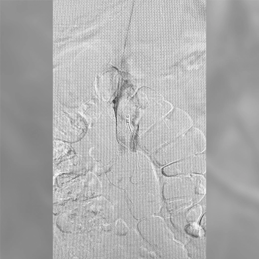 angiogram showing a catheter and guidewire positioned within a pelvic blood vessel, with contrast highlighting the vessel lumen during an intervention