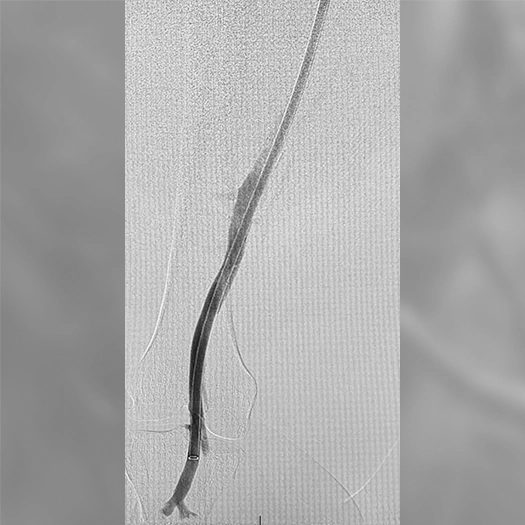 angiogram showing a catheter within a lower-extremity vein, with contrast outlining the vessel course following treatment