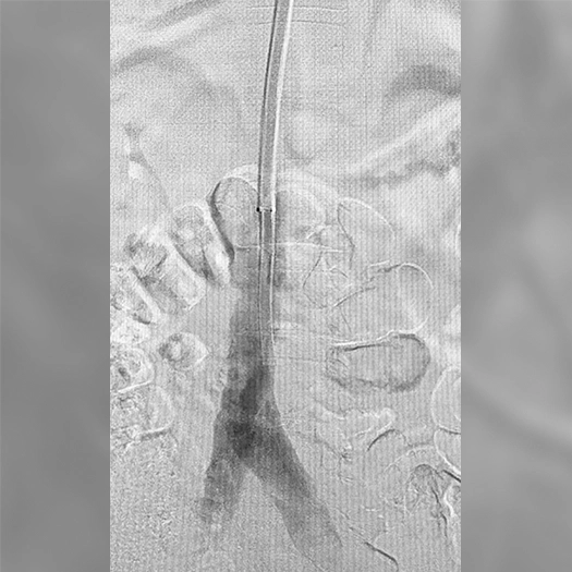 angiogram showing contrast flowing through a bifurcating pelvic or lower-extremity vein, with a catheter positioned centrally after an interventional procedure