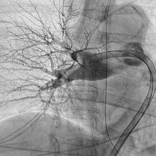 Angiogram of right pulmonary