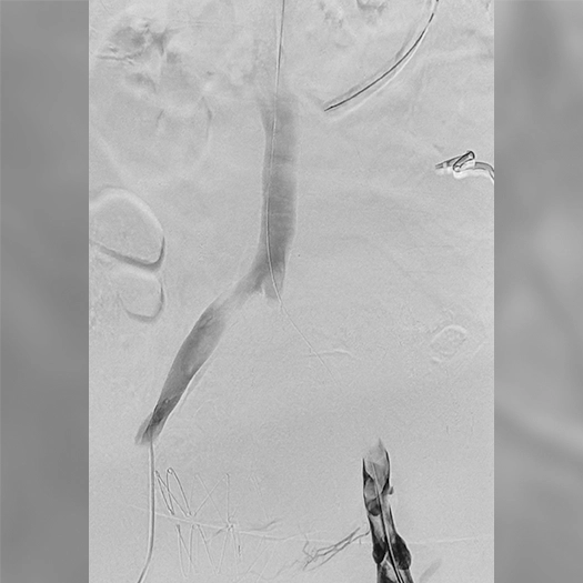 Angiogram showing a long, narrow blood vessel with contrast outlining the vessel lumen, and thin catheter wires visible near the lower portion of the image