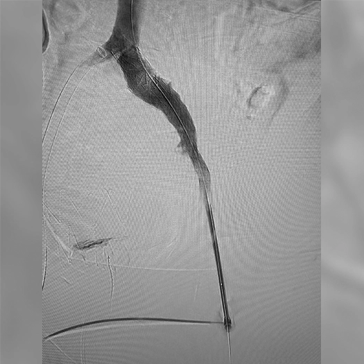 Angiogram showing contrast-filled branching pulmonary blood vessels with a catheter curved into a central vessel, illustrating vascular flow after an interventional procedure