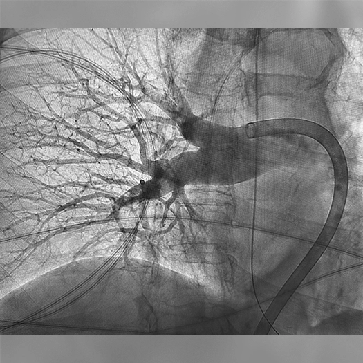 Angiogram showing a long, narrow catheter positioned within a blood vessel, with contrast outlining a tapered vascular segment following an interventional treatment