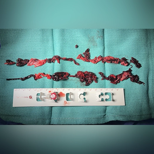Photograph of multiple irregular, dark red blood clots removed during a procedure, arranged horizontally on a teal surgical drape, with a white measurement guide placed below for scale