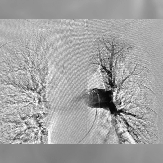 angiogram of both lungs showing contrast in the pulmonary arteries, with a catheter inserted into a central vessel prior to treatment