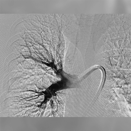 angiogram of the chest showing contrast-filled pulmonary arteries with a curved catheter positioned in a central vessel after treatment.