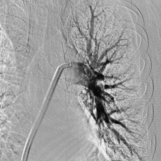 angiogram of branching pulmonary arteries filled with contrast, with a curved catheter positioned in a central vessel after treatment