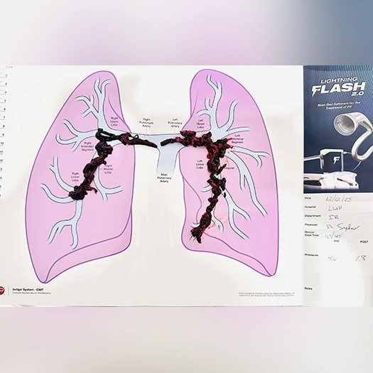 Photograph of dark red blood clots arranged along the branching pulmonary arteries on a labeled lung diagram, with a medical device advertisement and handwritten procedure notes visible on the right