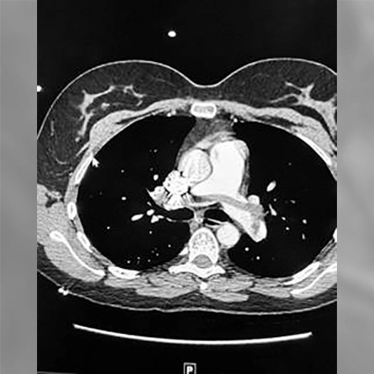 Axial CT scan of the chest showing the heart and pulmonary arteries, with contrast visible in the central vessels and surrounding lung tissue