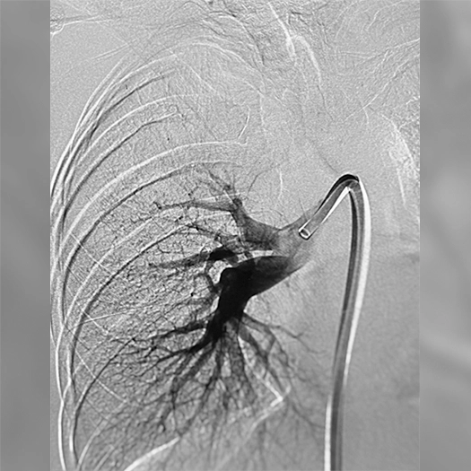 angiogram showing contrast pooling in a central pulmonary vessel, with a curved catheter tip positioned within the vessel lumen