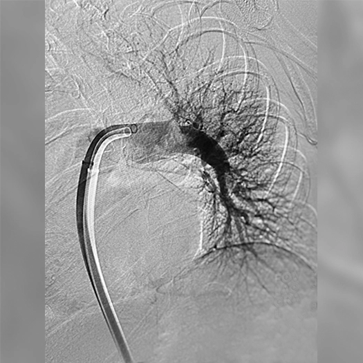 angiogram of pulmonary vasculature with contrast outlining dense branching vessels, while a curved catheter is positioned near the treated area