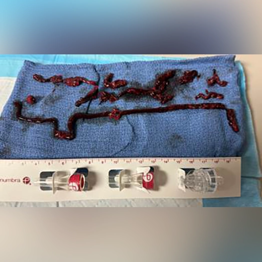 Photograph of multiple dark red blood clots removed during a procedure, arranged on a blue surgical drape with a measuring guide placed below for scale