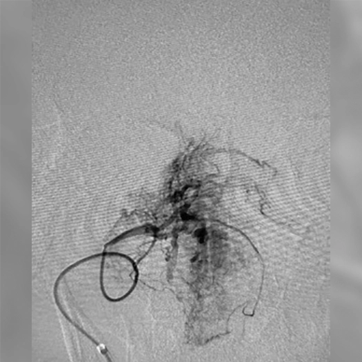 angiogram showing a catheter positioned near a dense cluster of vessels at the skull base with contrast highlighting the vascular structure
