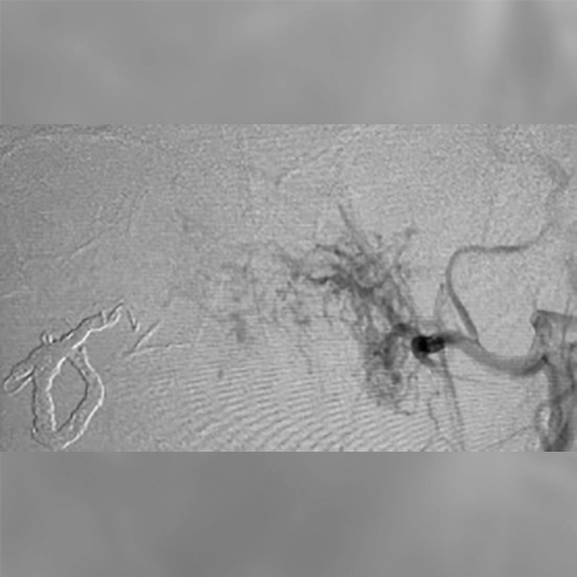 angiogram showing contrast filling a central vascular region with a dense network of vessels extending from a primary arterial source