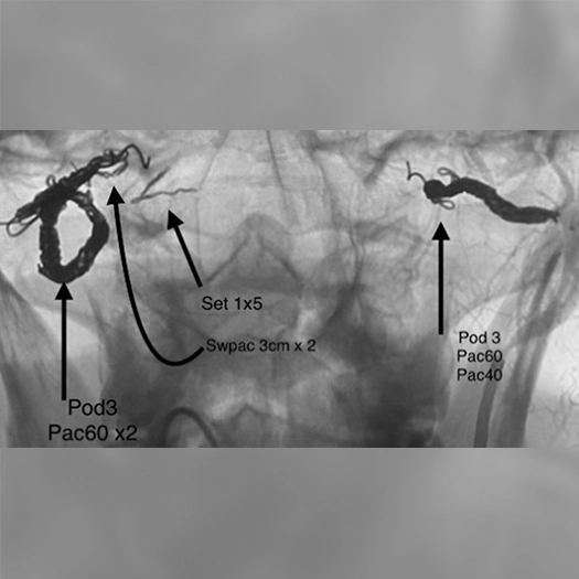 angiogram of the skull base with embolization devices in place, showing coils and embolic material with arrows and labels indicating device types and positions