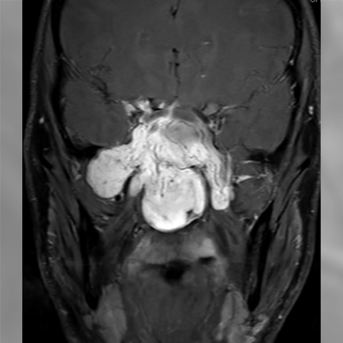 Coronal MRI of the head showing a large, bright mass centered at the skull base extending into surrounding sinus structures