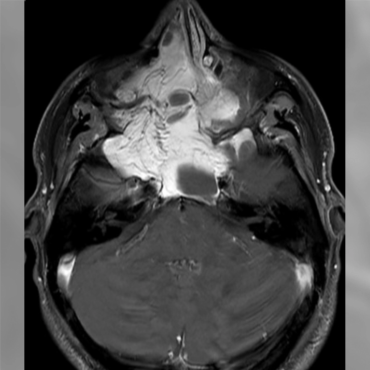 Axial MRI of the head showing a bright, irregular mass occupying the central skull base region above the nasal cavity