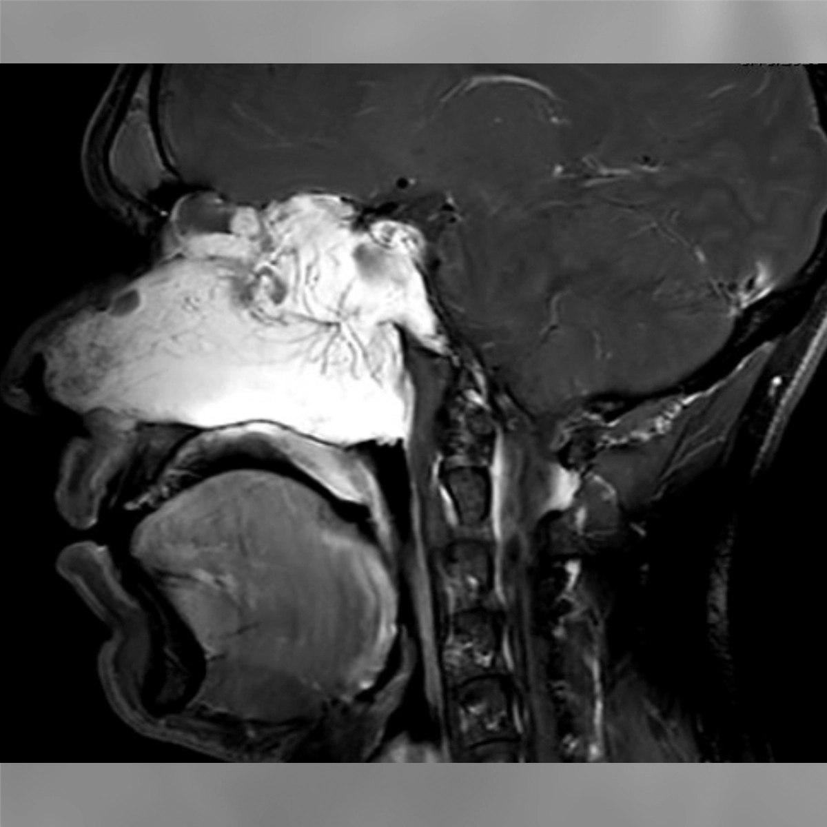 Sagittal MRI of the head showing a prominent mass at the skull base extending forward into the nasal and sinus area.