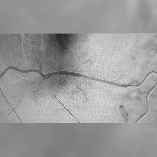 angiogram of coil deployment