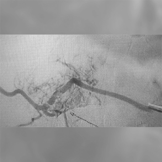 angiogram of coils