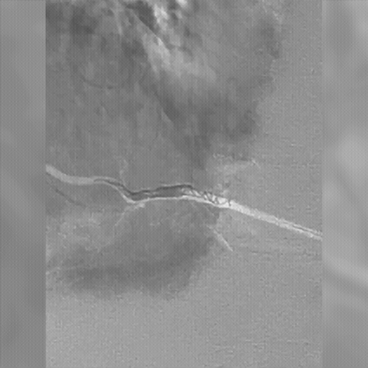 angiogram of coil deployment