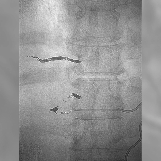 angiogram of post coil deployment