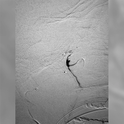 angiogram of artery embolization