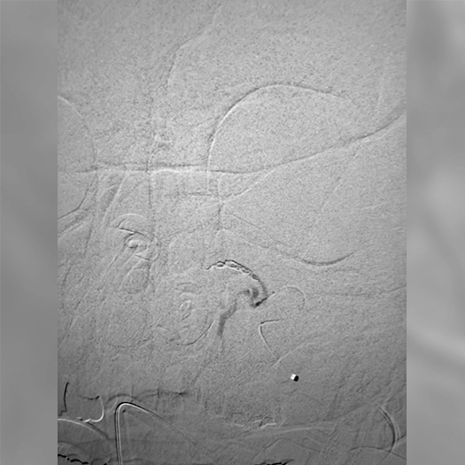 angiogram of post artery embolization
