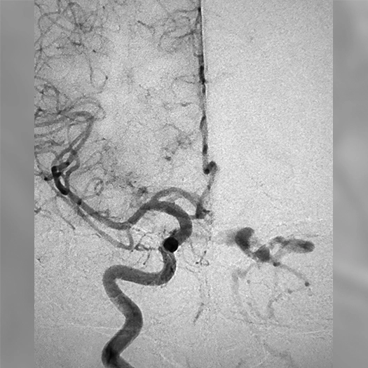 angiogram showing a tortuous feeding artery with contrast outlining a vascular lesion before treatment