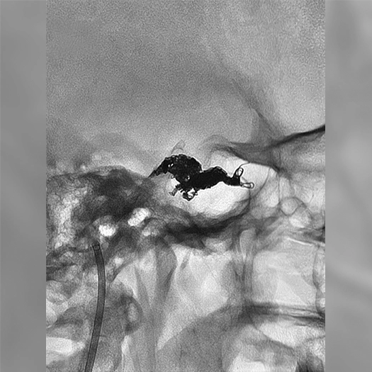 angiogram showing a compact cluster of coils within a treated vascular lesion at the skull base, with surrounding vessels faintly visible