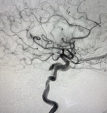 angiogram showing a tortuous intracranial artery with branching vessels before intervention